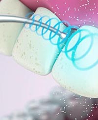 чистка ультразвуком