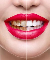 профессиональная гигиена полости рта