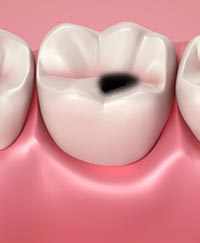 лечение кариеса