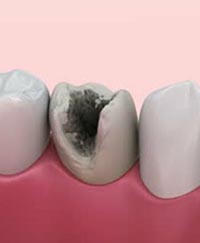 лечение глубокого кариеса