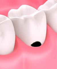 пришеечный кариес